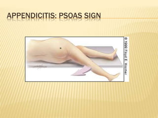 APPENDICITIS: PSOAS SIGN
 