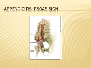 APPENDICITIS: PSOAS SIGN
 