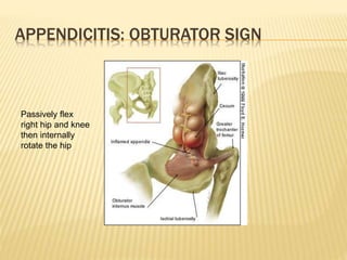 APPENDICITIS: OBTURATOR SIGN
Passively flex
right hip and knee
then internally
rotate the hip
 