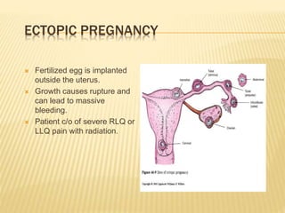 ECTOPIC PREGNANCY
 Fertilized egg is implanted
outside the uterus.
 Growth causes rupture and
can lead to massive
bleeding.
 Patient c/o of severe RLQ or
LLQ pain with radiation.
 