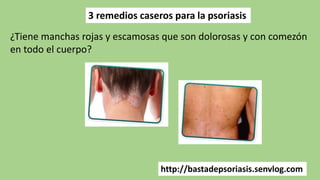 3 remedios caseros para la psoriasis
http://bastadepsoriasis.senvlog.com
¿Tiene manchas rojas y escamosas que son dolorosas y con comezón
en todo el cuerpo?
 