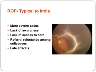 Effos Rop Dr Azad on ROP: Need for training and screening | PPT
