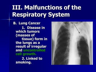 III. Malfunctions of the
Respiratory System
B. Lung Cancer
1. Disease in
which tumors
(masses of
tissue) form in
the lungs...
