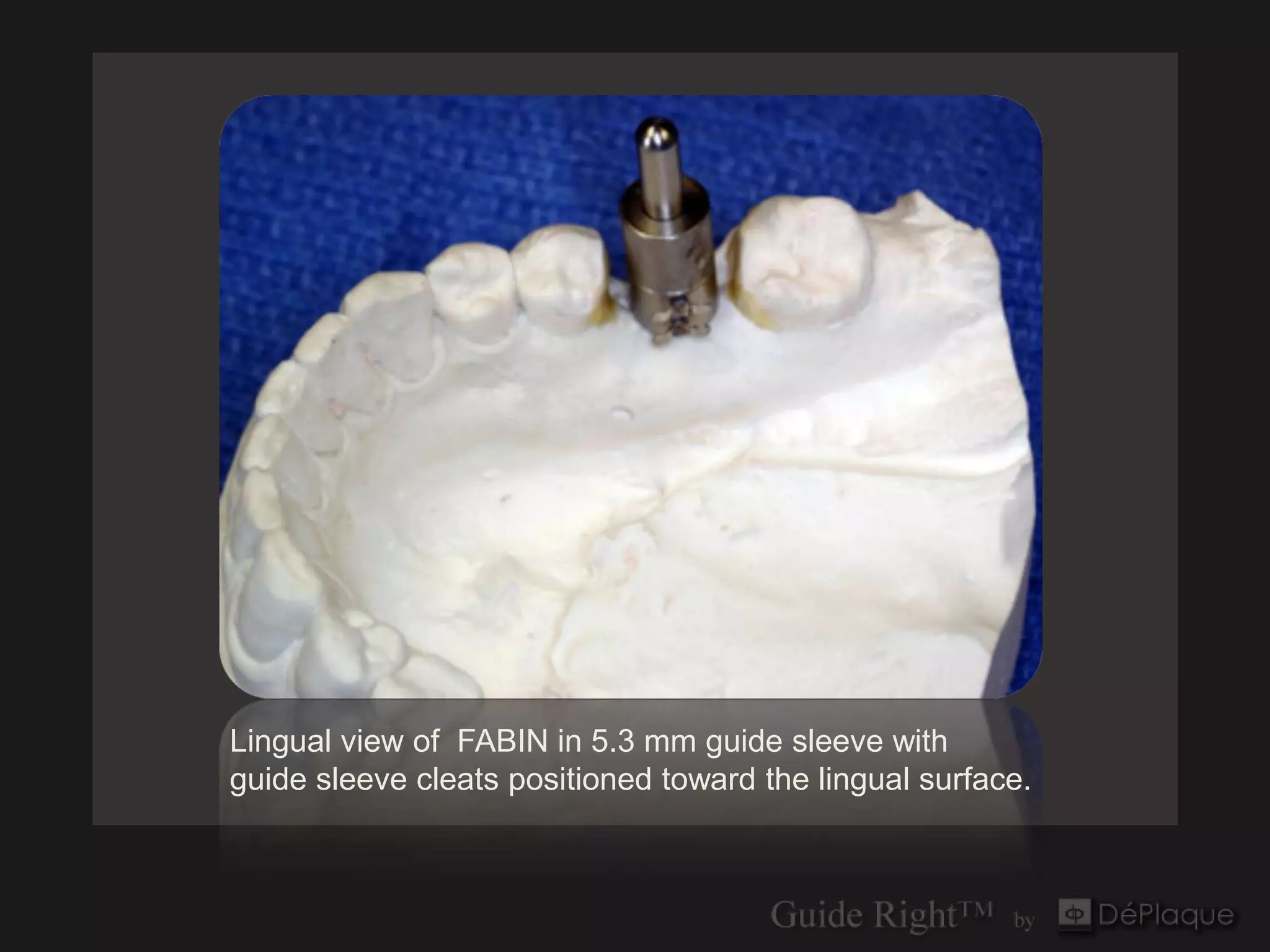 Lingual view of FABIN in 5.3 mm guide sleeve with
guide sleeve cleats positioned toward the lingual surface.
 