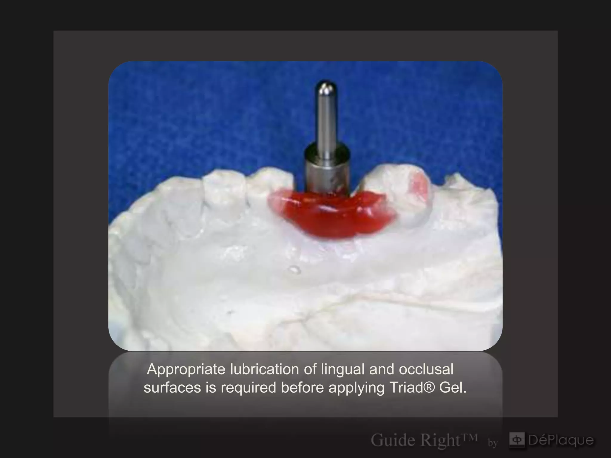 Appropriate lubrication of lingual and occlusal
surfaces is required before applying Triad® Gel.
 