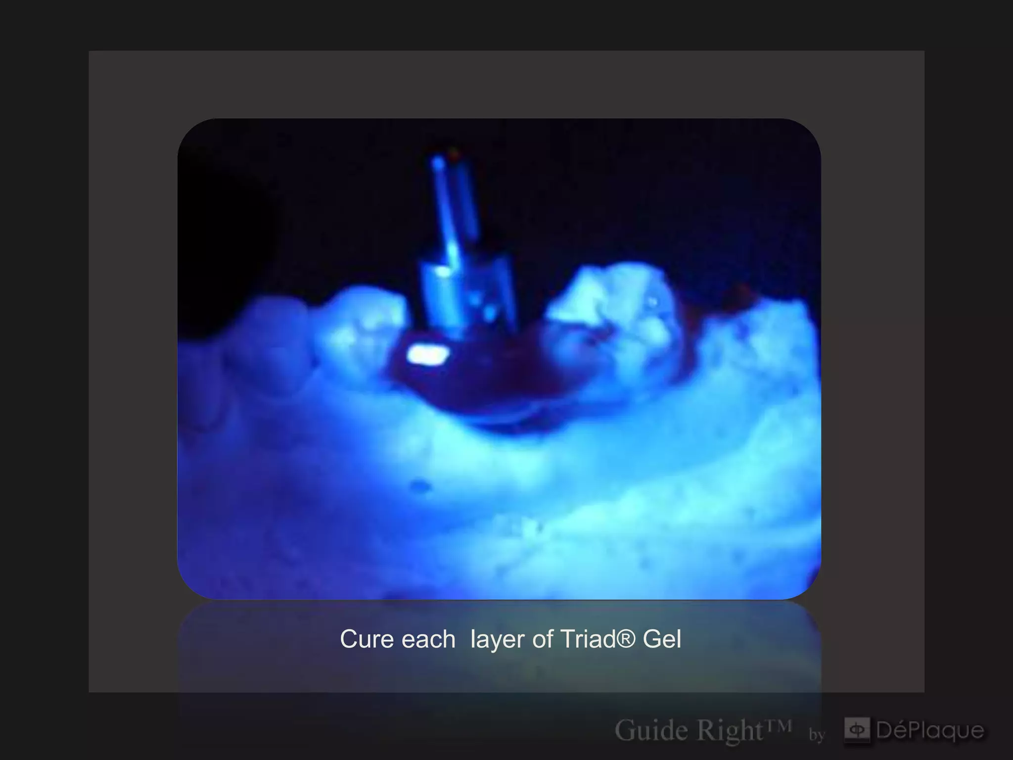 Cure each layer of Triad® Gel
 