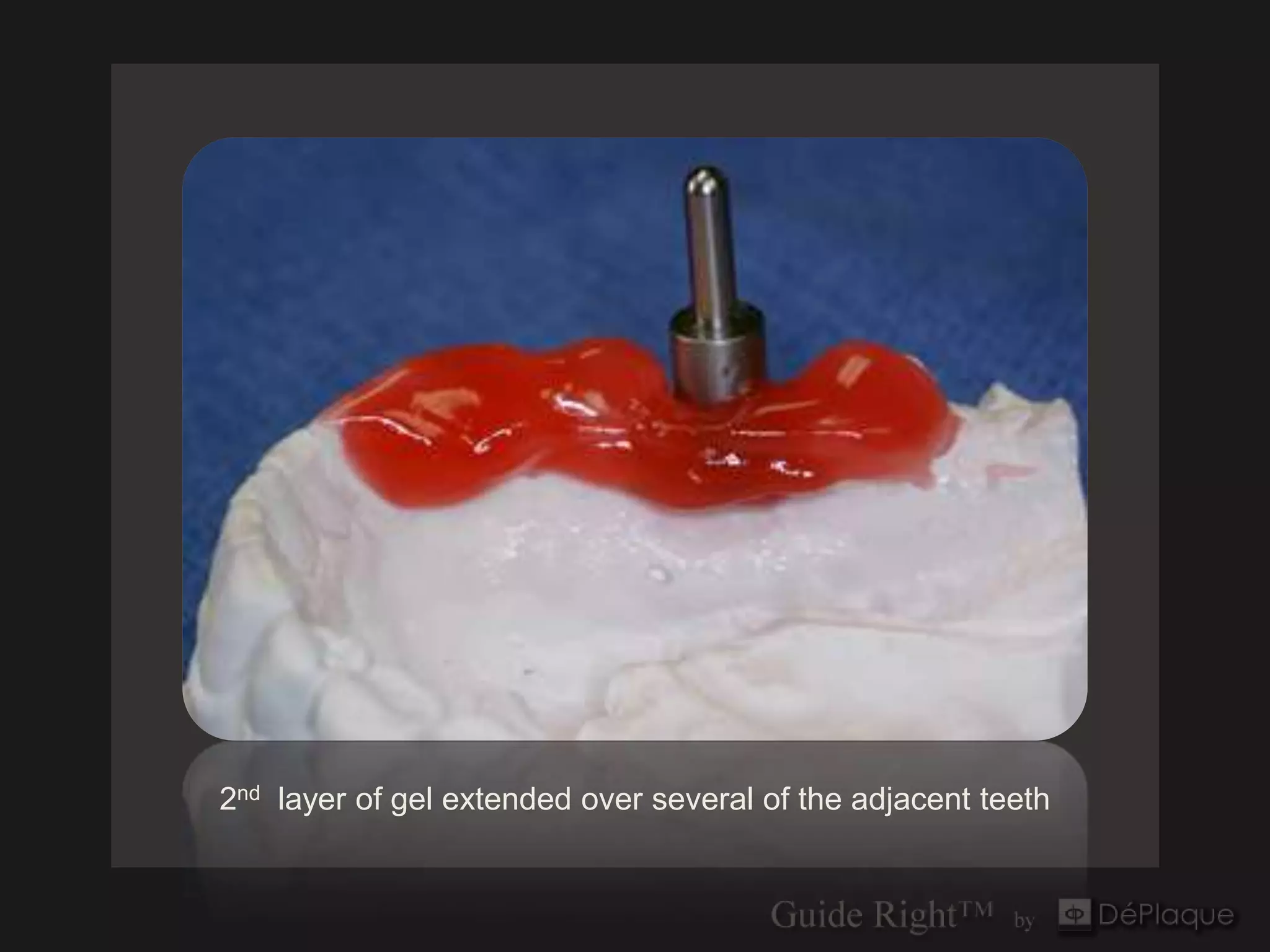 2nd layer of gel extended over several of the adjacent teeth
 