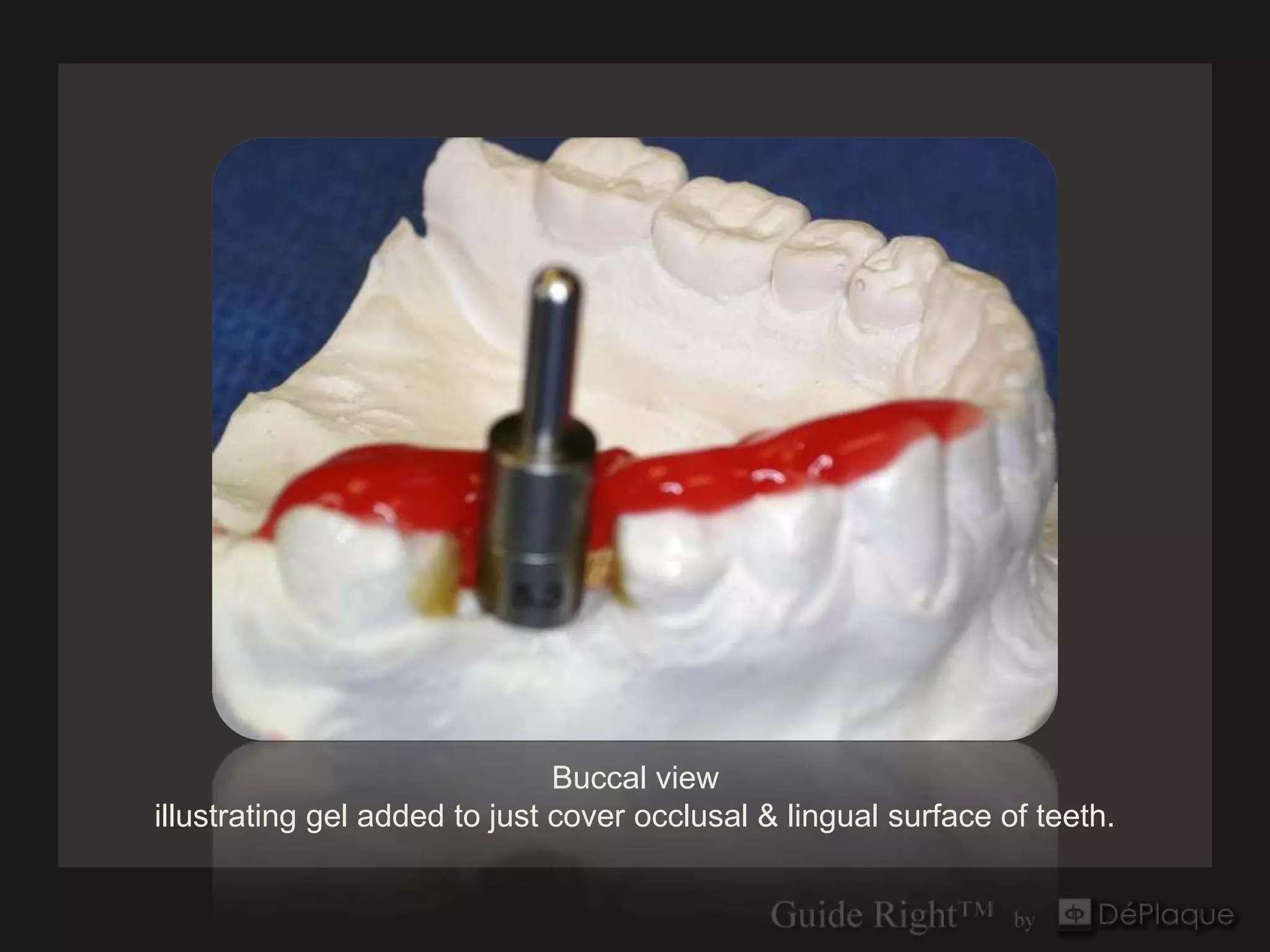 Buccal view
illustrating gel added to just cover occlusal & lingual surface of teeth.
 