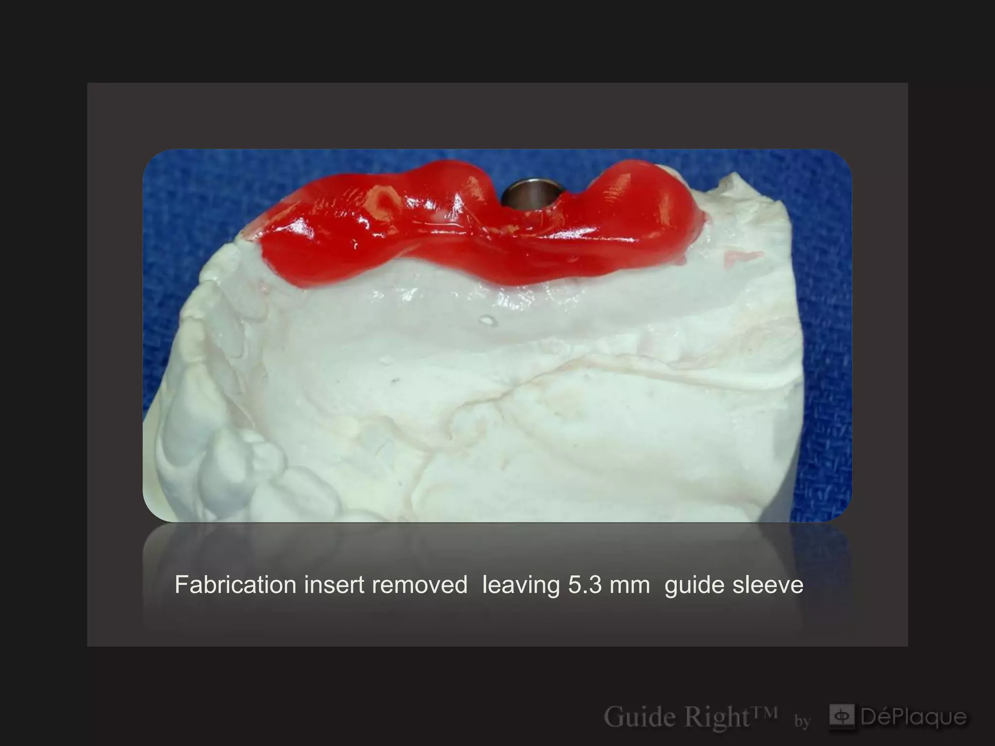 Fabrication insert removed leaving 5.3 mm guide sleeve
 