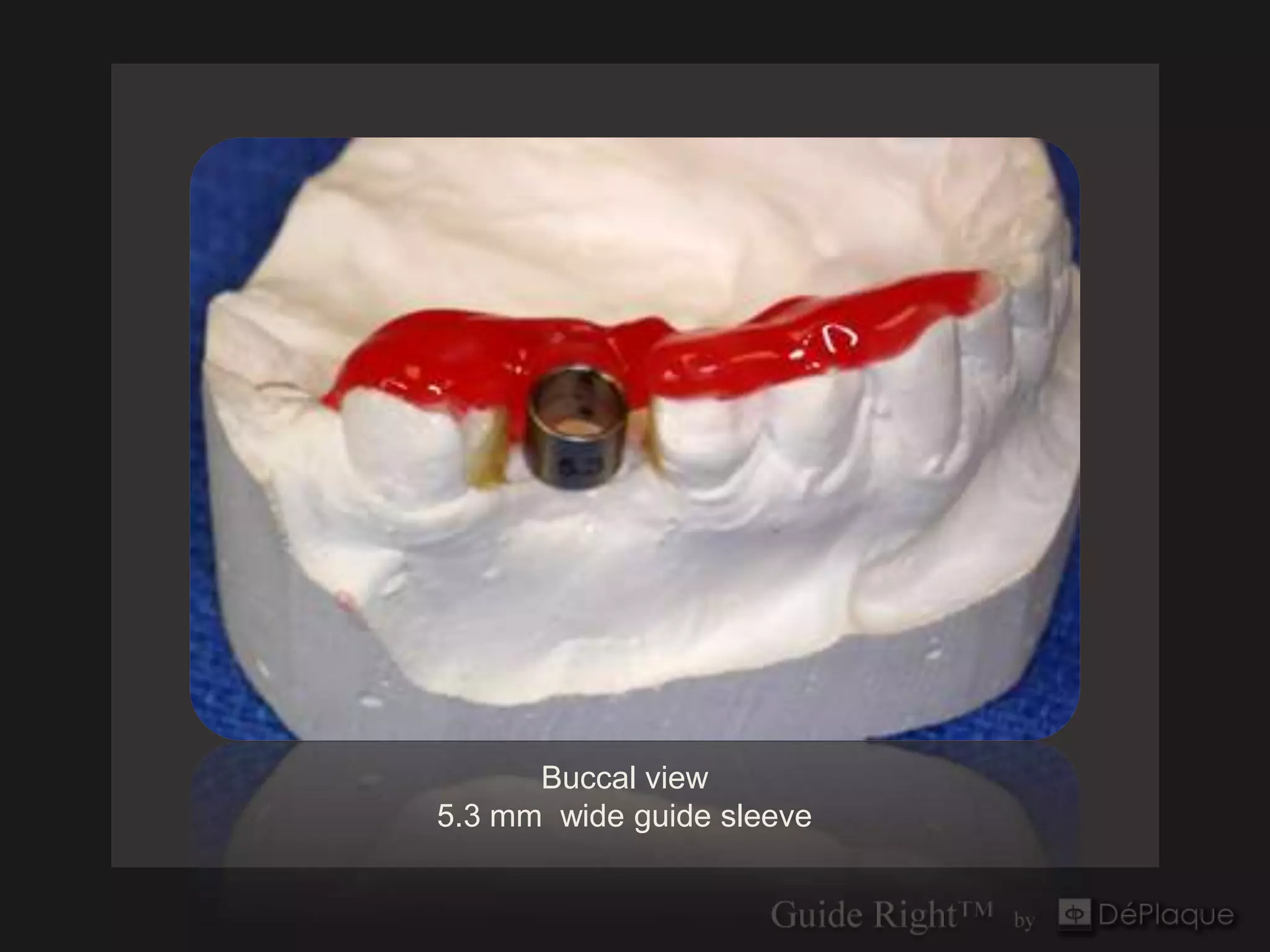Buccal view
5.3 mm wide guide sleeve
 
