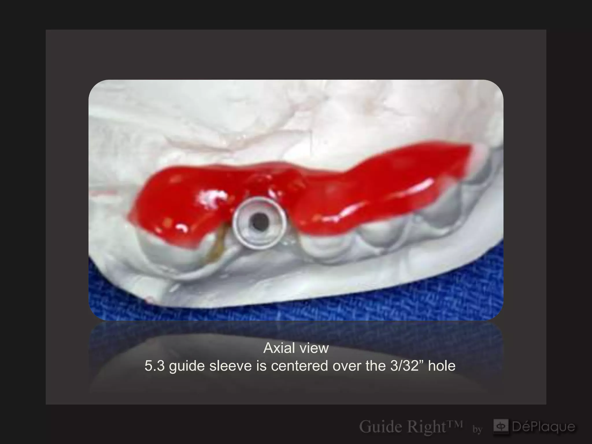 Axial view
5.3 guide sleeve is centered over the 3/32” hole
 