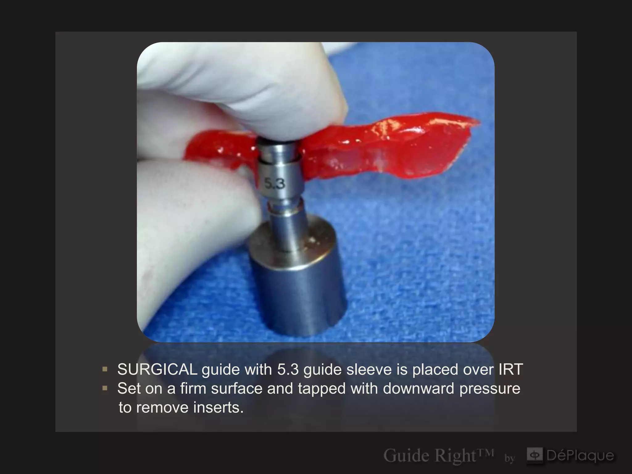  SURGICAL guide with 5.3 guide sleeve is placed over IRT
 Set on a firm surface and tapped with downward pressure
  to remove inserts.
 
