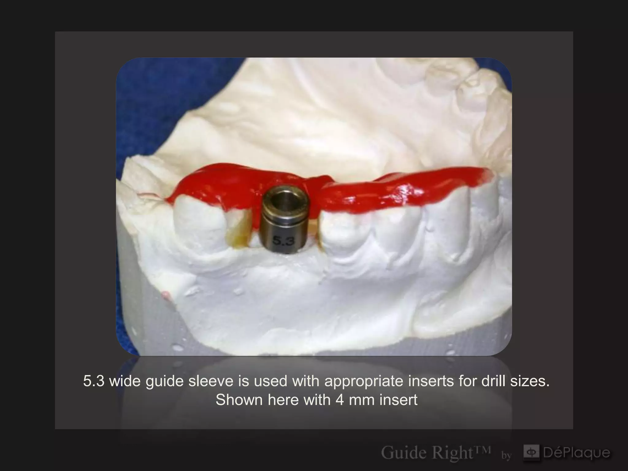 5.3 wide guide sleeve is used with appropriate inserts for drill sizes.
                   Shown here with 4 mm insert
 
