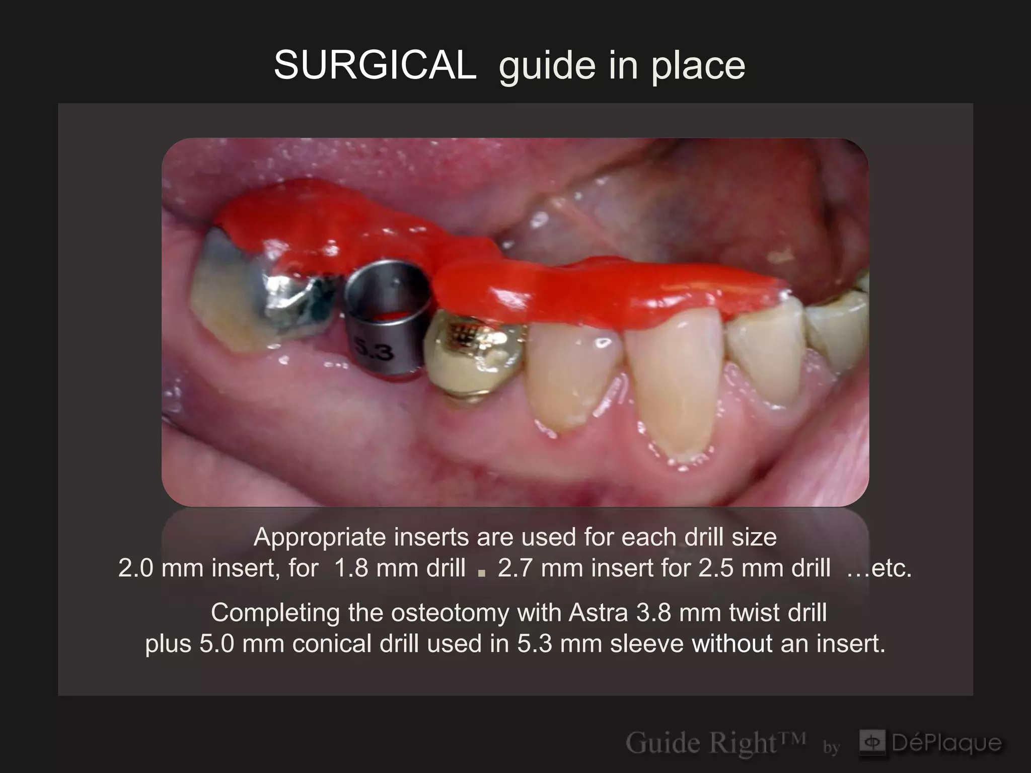 SURGICAL guide in place




           Appropriate inserts are used for each drill size
2.0 mm insert, for 1.8 mm drill ■ 2.7 mm insert for 2.5 mm drill …etc.
        Completing the osteotomy with Astra 3.8 mm twist drill
  plus 5.0 mm conical drill used in 5.3 mm sleeve without an insert.
 