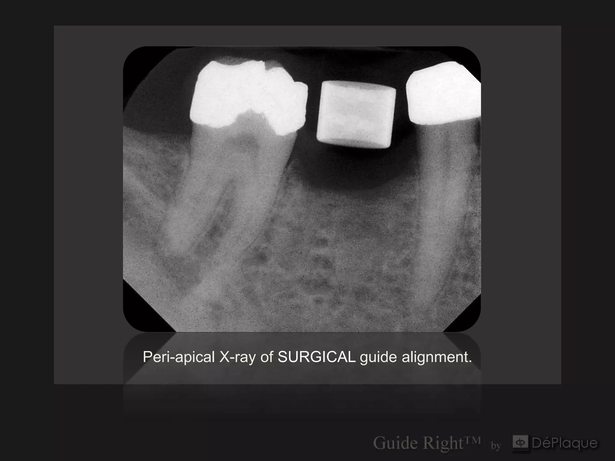 Peri-apical X-ray of SURGICAL guide alignment.
 