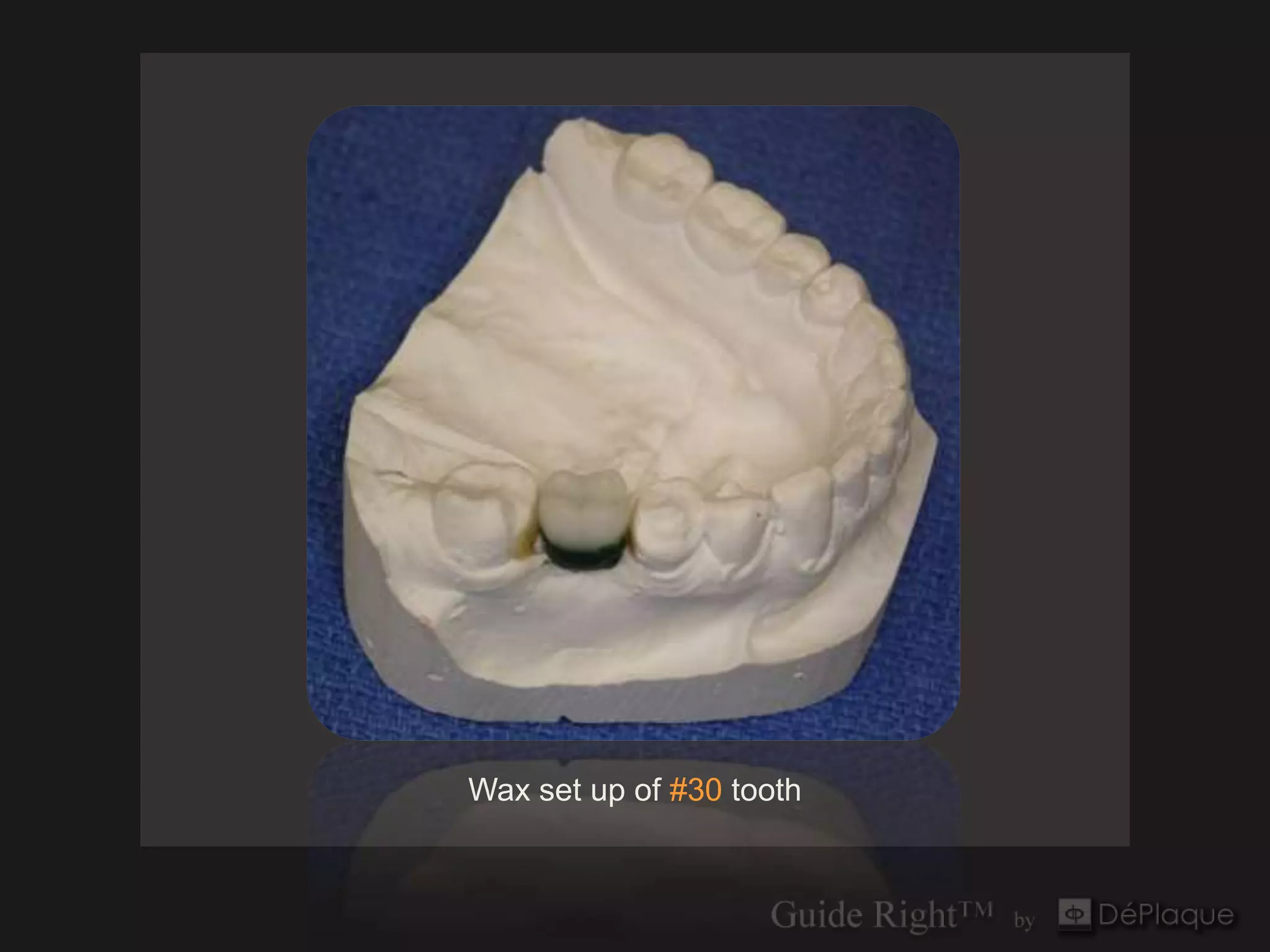 Wax set up of #30 tooth
 