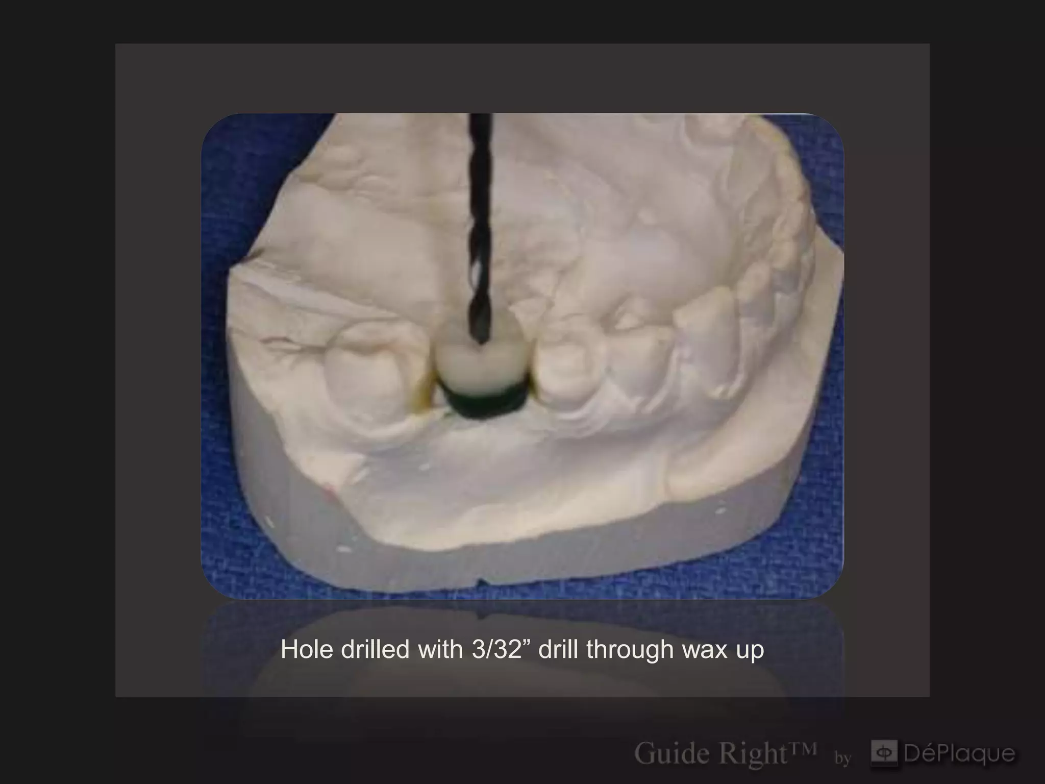 Hole drilled with 3/32” drill through wax up
 