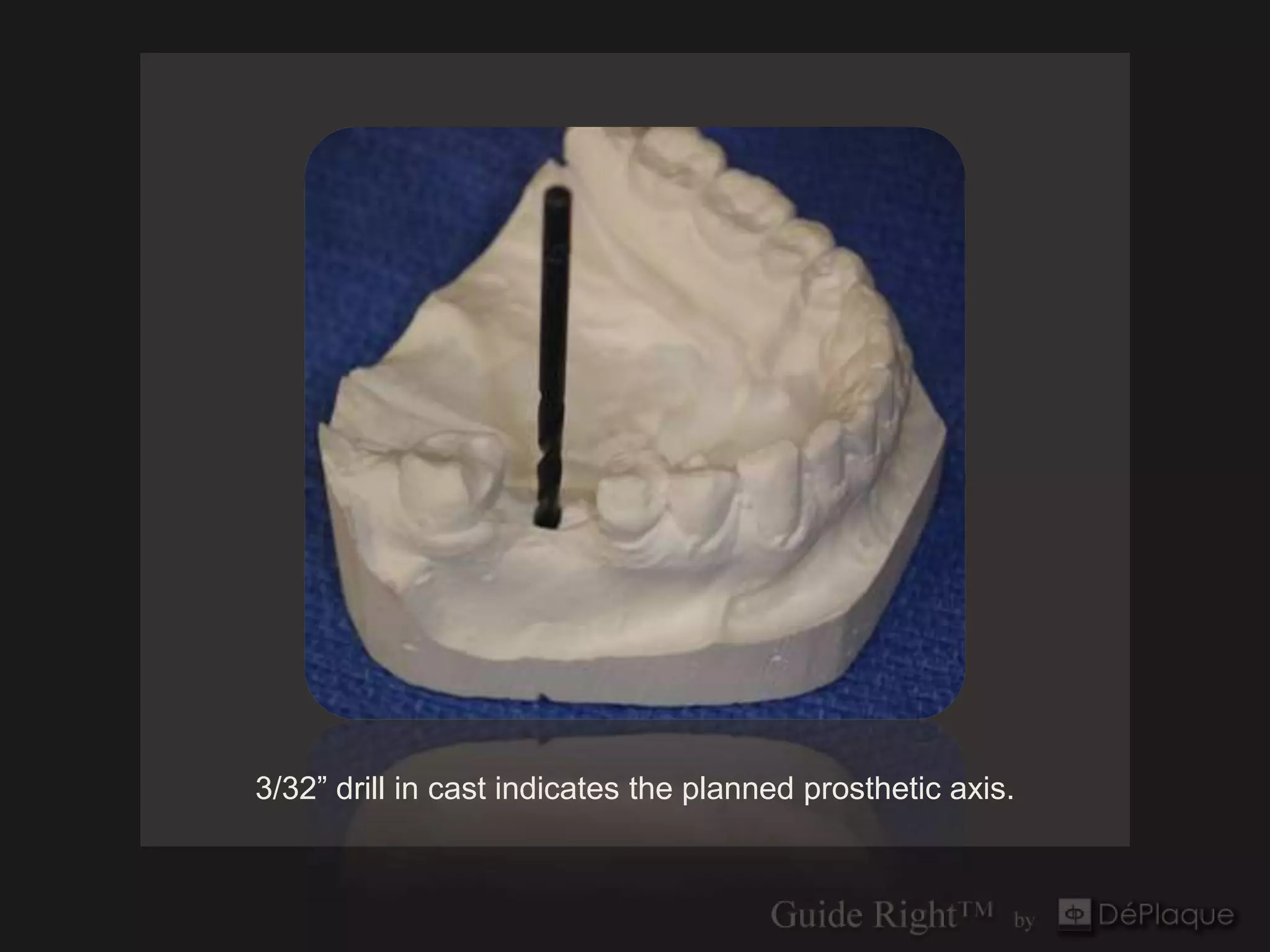 3/32” drill in cast indicates the planned prosthetic axis.
 