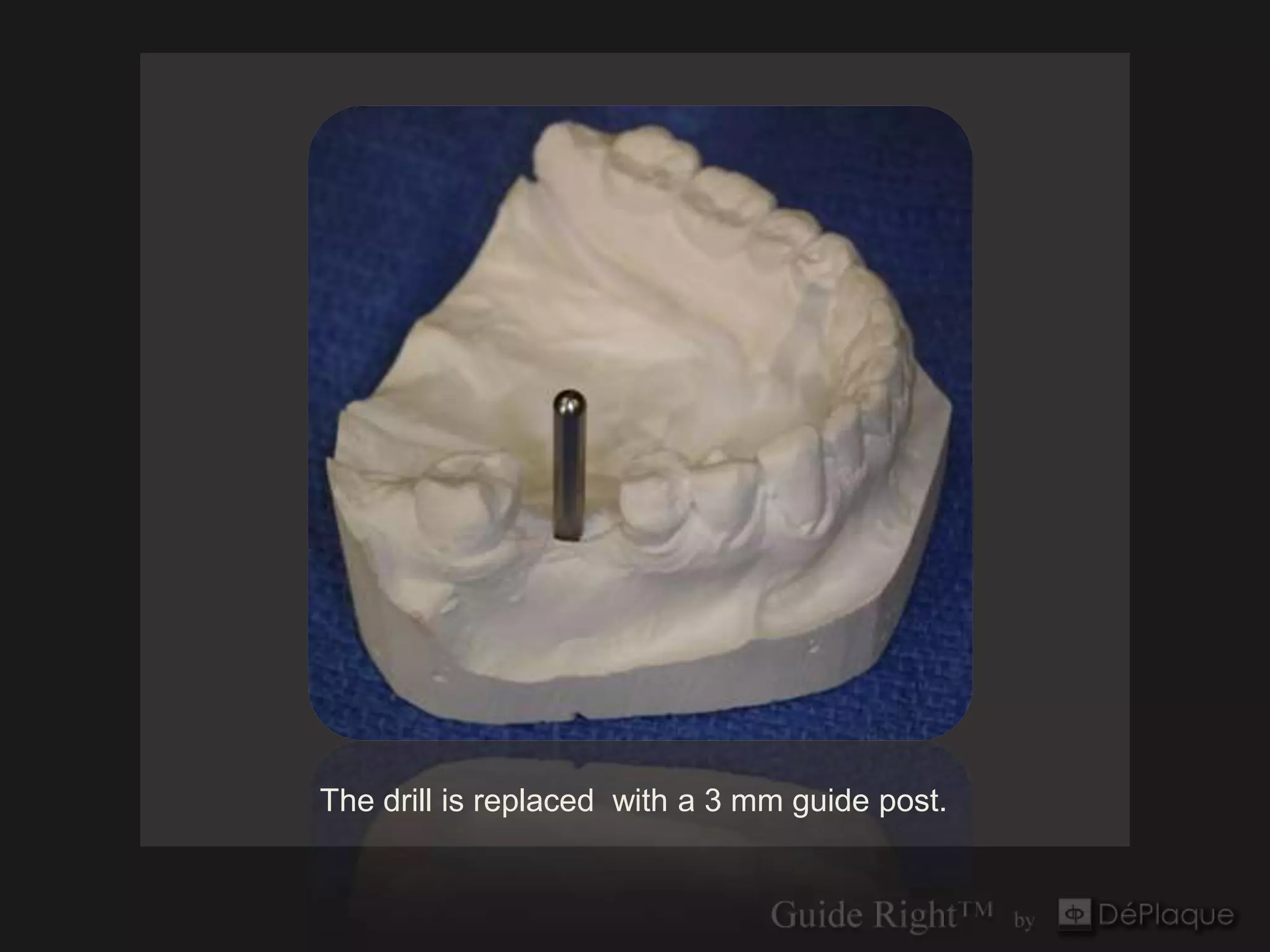 The drill is replaced with a 3 mm guide post.
 