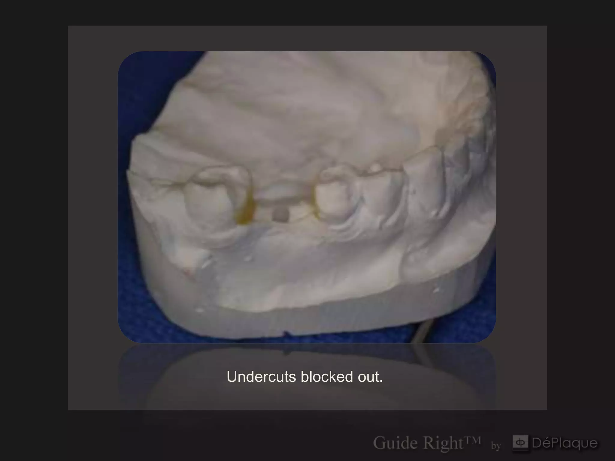 Undercuts blocked out.
 