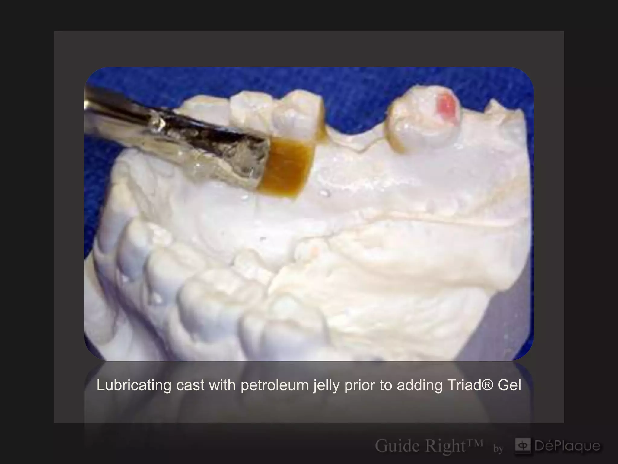 Lubricating cast with petroleum jelly prior to adding Triad® Gel
 