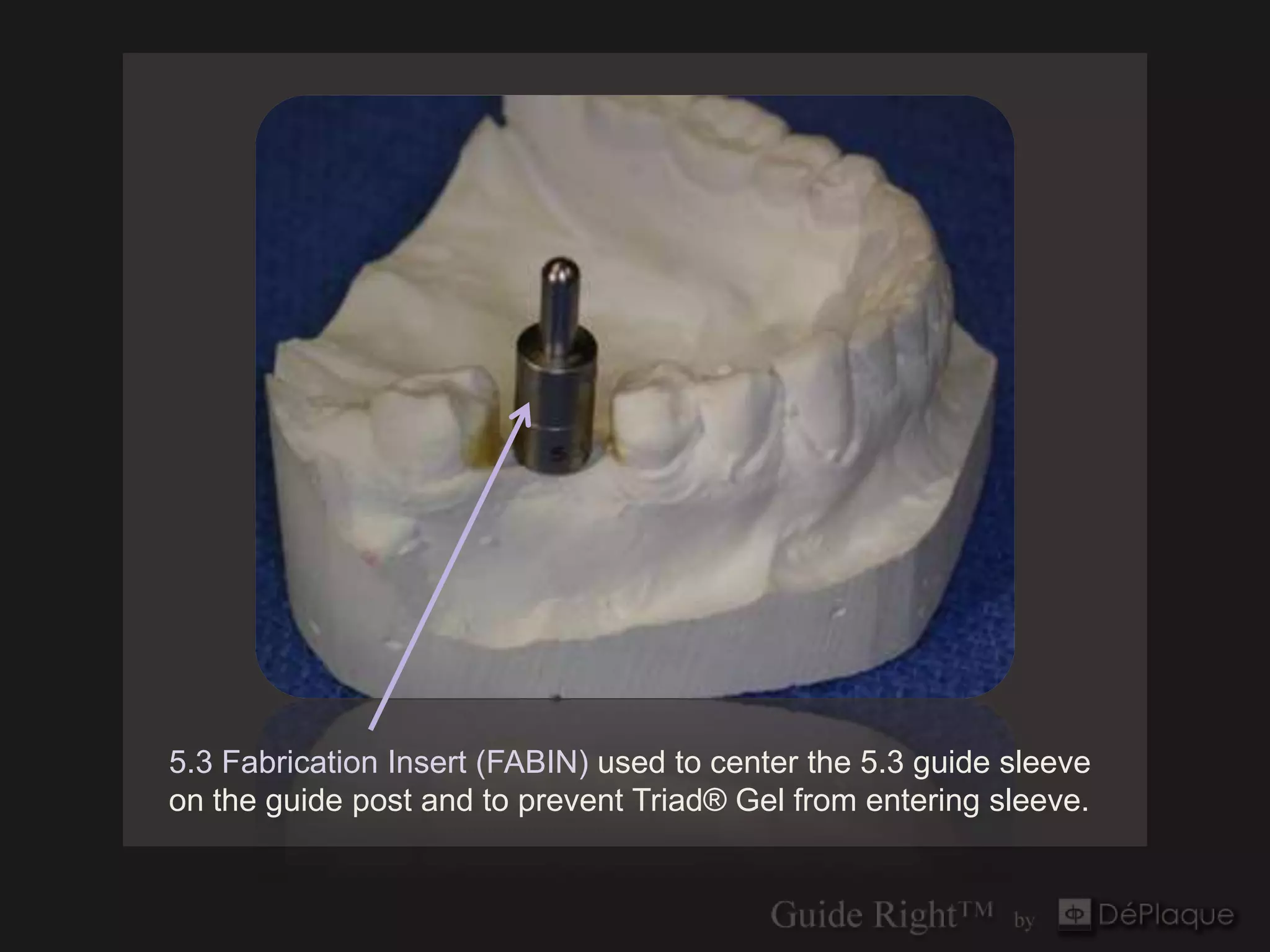 5.3 Fabrication Insert (FABIN) used to center the 5.3 guide sleeve
on the guide post and to prevent Triad® Gel from entering sleeve.
 