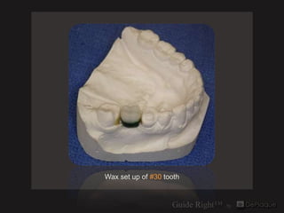 Wax set up of #30 tooth
 