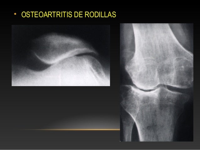 desgaste de rodilla rx
