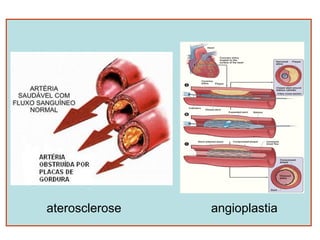 aterosclerose   angioplastia
 