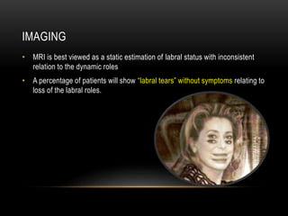 IMAGING 
• MRI is best viewed as a static estimation of labral status with inconsistent 
relation to the dynamic roles 
• A percentage of patients will show “labral tears” without symptoms relating to 
loss of the labral roles. 
 