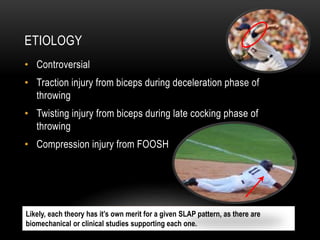 ETIOLOGY 
• Controversial 
• Traction injury from biceps during deceleration phase of 
throwing 
• Twisting injury from biceps during late cocking phase of 
throwing 
• Compression injury from FOOSH 
Likely, each theory has it’s own merit for a given SLAP pattern, as there are 
biomechanical or clinical studies supporting each one. 
 