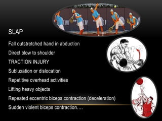 SLAP 
Fall outstretched hand in abduction 
Direct blow to shoulder 
TRACTION INJURY 
Subluxation or dislocation 
Repetitive overhead activities 
Lifting heavy objects 
Repeated eccentric biceps contraction (deceleration) 
Sudden violent biceps contraction…. 
 
