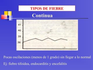 TIPOS DE FIEBRE
Pocas oscilaciones (menos de 1 grado) sin llegar a lo normal
Ej: fiebre tifoidea, endocarditis y encefalitis
Continua
 