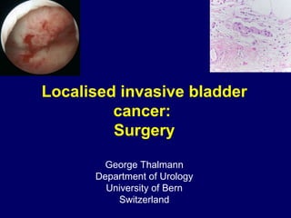 Localised invasive bladder cancer:  Surgery George Thalmann Department of Urology University of Bern Switzerland 