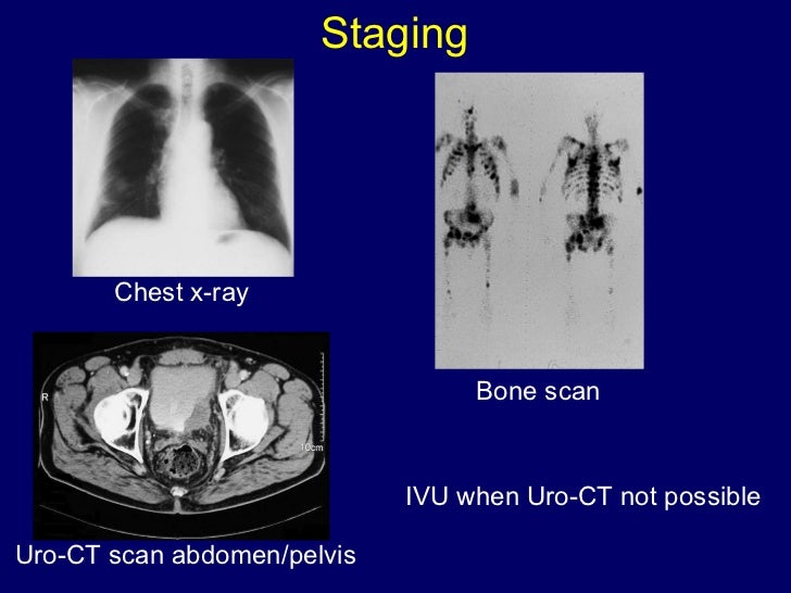 ECCLU 2011 - G. Thalmann - Localised invasive bladder ...