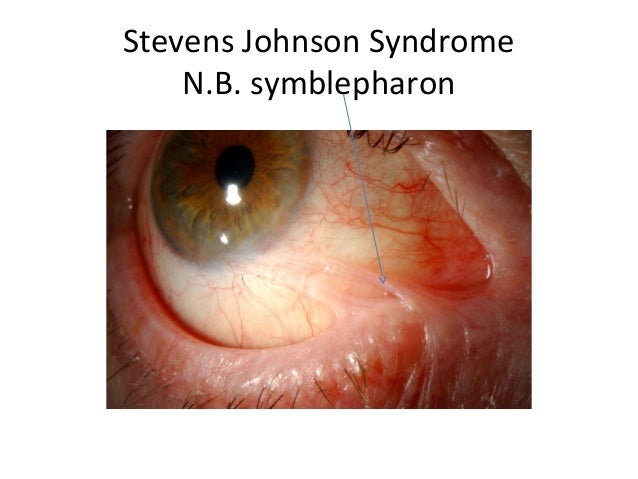 Conjunctiva