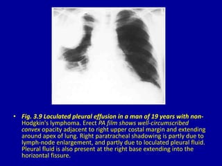 3 the pleura | PPTX