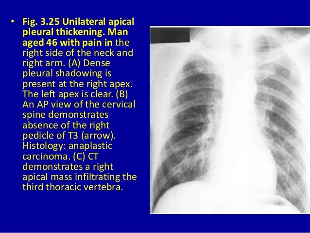 3 the pleura