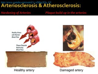 http://www.youtube.com/watch?v=xN0qyX2n_AY

Healthy artery

Damaged artery

 