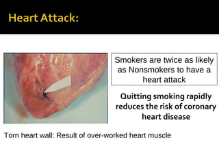 Smokers are twice as likely
as Nonsmokers to have a
heart attack

Quitting smoking rapidly
reduces the risk of coronary
heart disease
Torn heart wall: Result of over-worked heart muscle

 