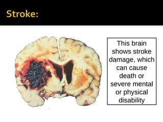 This brain
shows stroke
damage, which
can cause
death or
severe mental
or physical
disability

 