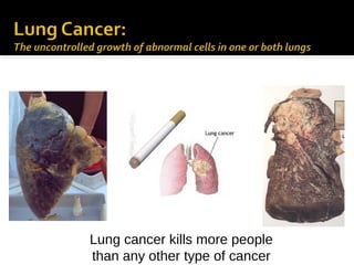 Lung cancer kills more people
than any other type of cancer

 