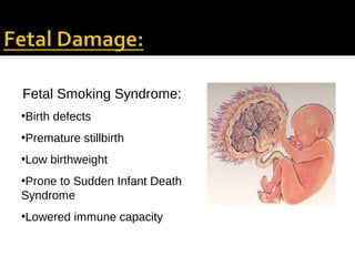 Fetal Smoking Syndrome:
•Birth defects
•Premature stillbirth
•Low birthweight
•Prone to Sudden Infant Death
Syndrome
•Lowered immune capacity

 
