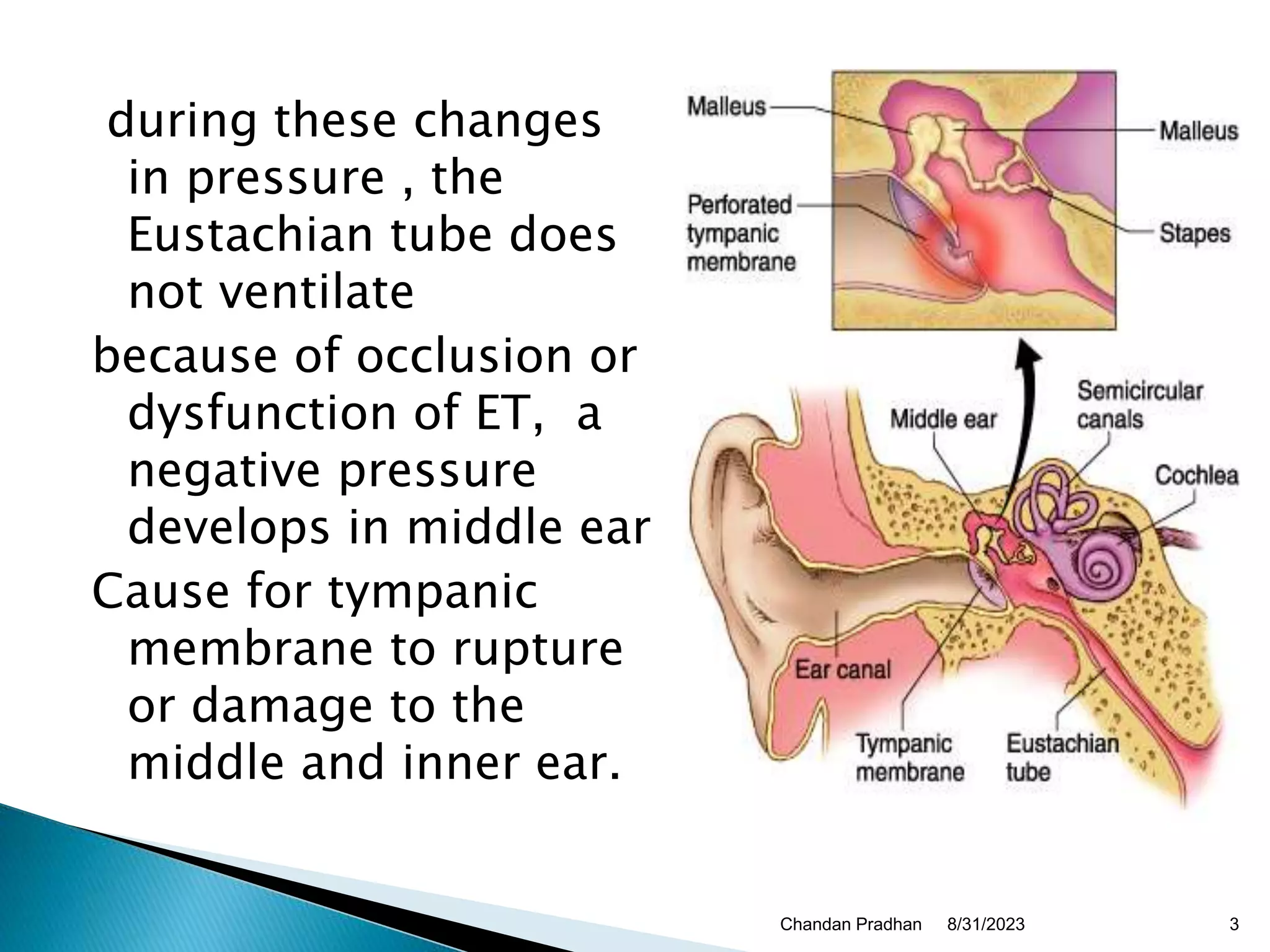 Trauma or Perforation in tympanum.ppt