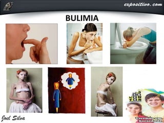 BULIMIA
 