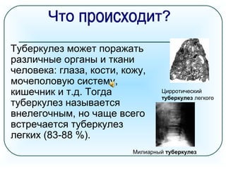Туберкулез может поражать
различные органы и ткани
человека: глаза, кости, кожу,
мочеполовую систему,
кишечник и т.д. Тогда
туберкулез называется
внелегочным, но чаще всего
встречается туберкулез
легких (83-88 %).
Цирротический
туберкулез легкого
Милиарный туберкулез
 