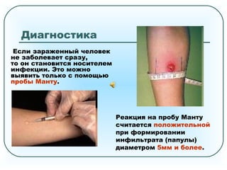 Диагностика
Если зараженный человек
не заболевает сразу,
то он становится носителем
инфекции. Это можно
выявить только с помощью
пробы Манту.
Реакция на пробу Манту
считается положительной
при формировании
инфильтрата (папулы)
диаметром 5мм и более.
 