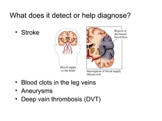 What does it detect or help diagnose? Stroke Blood clots in the leg veins Aneurysms  Deep vain thrombosis (DVT) 