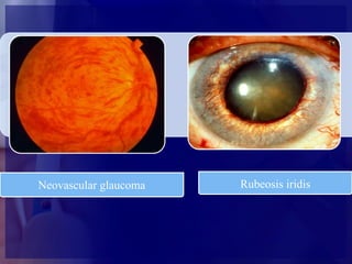 Diabetic retinopathy | PPTX
