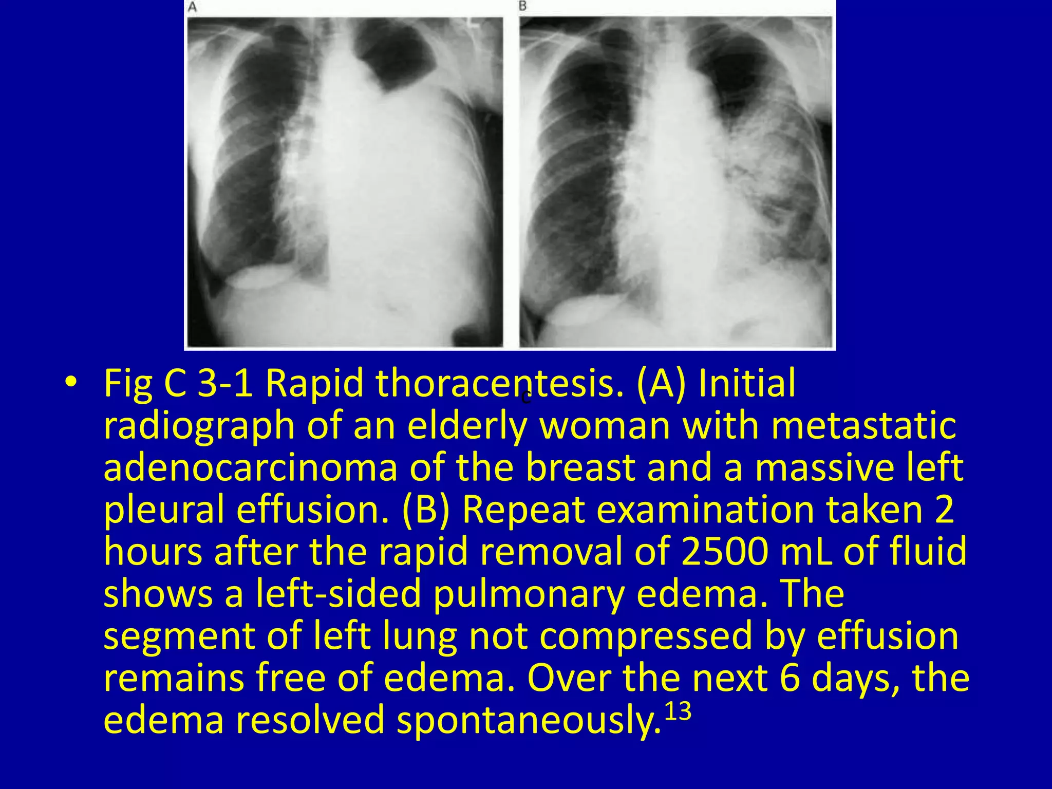 • Fig C 3-1 Rapid thoracentesis. (A) Initial
radiograph of an elderly woman with metastatic
adenocarcinoma of the breast and a massive left
pleural effusion. (B) Repeat examination taken 2
hours after the rapid removal of 2500 mL of fluid
shows a left-sided pulmonary edema. The
segment of left lung not compressed by effusion
remains free of edema. Over the next 6 days, the
edema resolved spontaneously.13
c